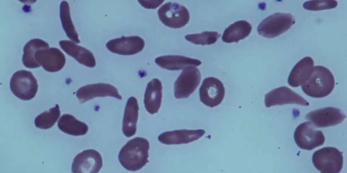 Image de microscope montrant les globules rouges en forme de faucille d’un patient atteint de drépanocytose. © AP/SIPA
