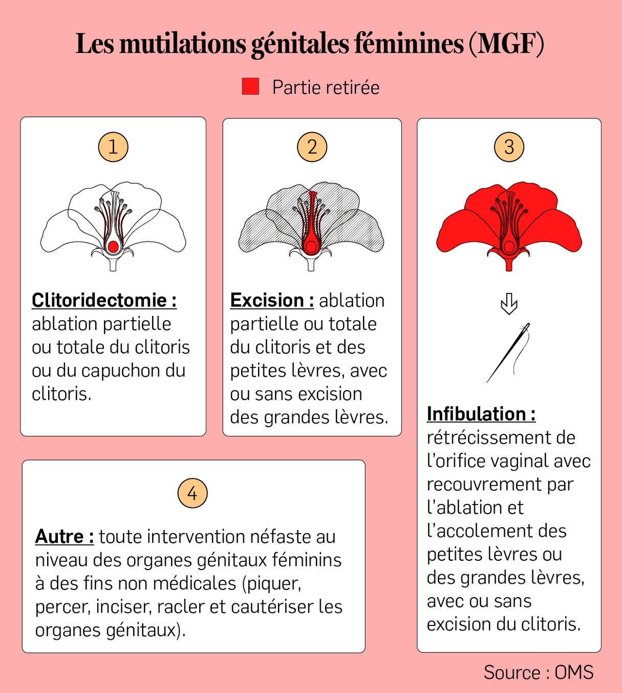 L'excision est une forme de mutilation génitale féminine, que l'OMS définit comme l'ablation partielle ou totale des petites lèvres. &copy; Infographie : Maÿlis DUDOUET