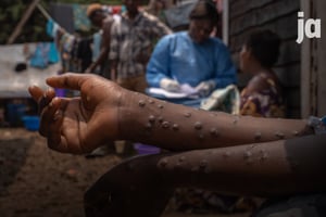 Un patient atteint par le Mpox, à l’hôpital de Kavumu, au nord de Bukavu, en RDC, le 24 août 2024. © Photo by Glody MURHABAZI / AFP