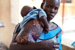 Une Soudanaise et son enfant souffrant de malnutrition à Juba, le 14 mars 2014. © Ivan Lieman