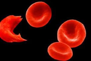 Chez la personne drépanocytaire, les globules rouges prennent la forme allongée d’une faucille. © DR