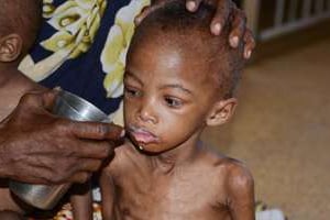Un enfant souffrant de malnutrition dans un hôpital de Mogadiscio, en Somalie, mai 2014. © Mohamed Abdiwahab/AFP