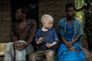 Un enfant albinos avec ses parents, le 17 avril 2015, dans le district de Machinga, dans le sud du Malawi. © AFP